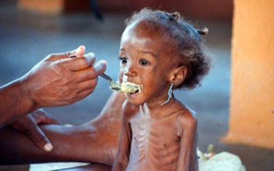 What is malnutrition ?